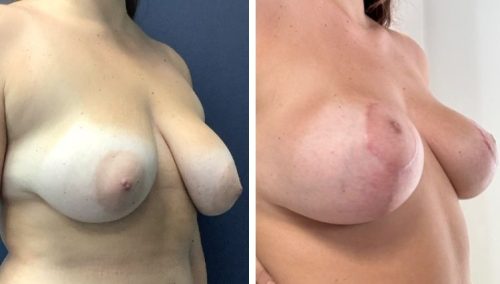 Restoring confidence: Before and after breast lift in Colombia