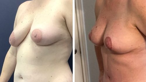 Vertical breast lift results in Colombia for improved projection