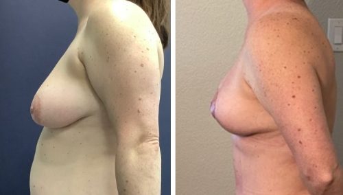 Colombia Vertical breast lift results for improved projection